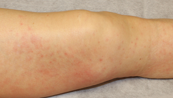 cellulitis_01.jpg