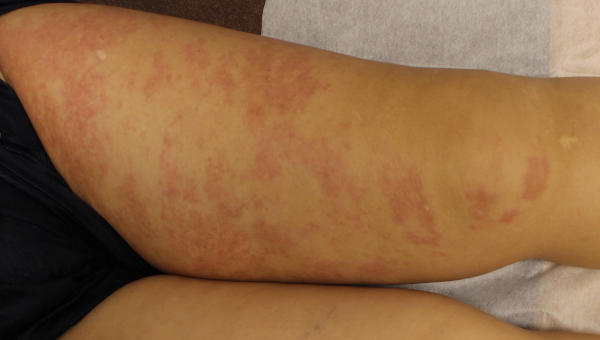 cellulitis_02.jpg