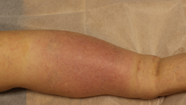cellulitis_03.jpg