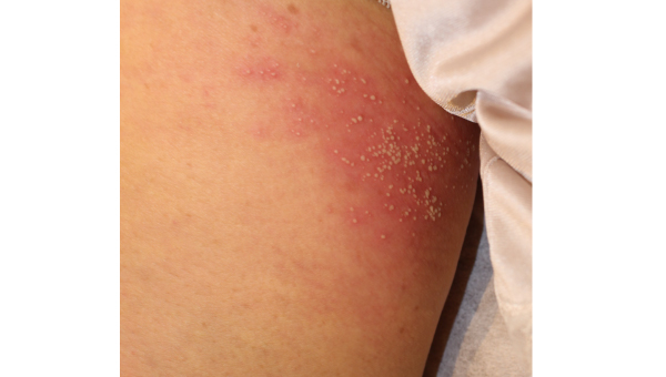 cellulitis_04.jpg