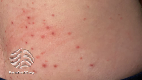 cellulitis_05.jpg