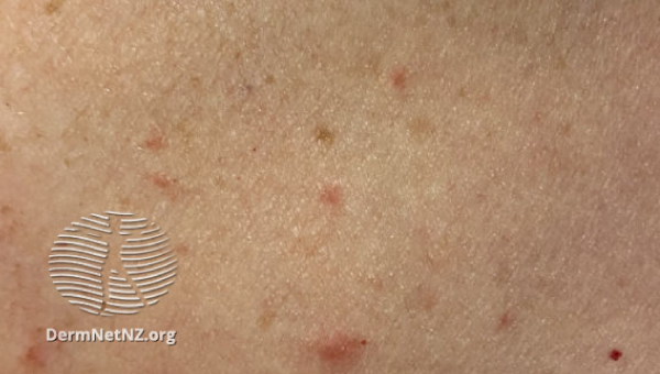cellulitis_06.jpg