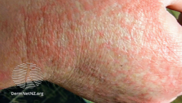 cellulitis_07.jpg