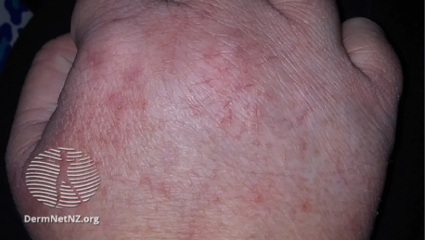 cellulitis_08.jpg