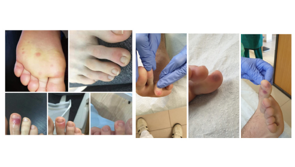 cellulitis_09.jpg
