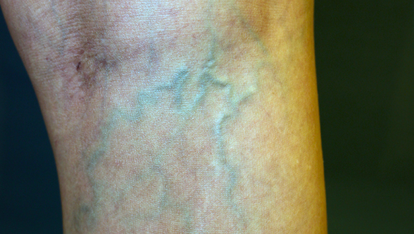 231201_varicose_veins.jpg