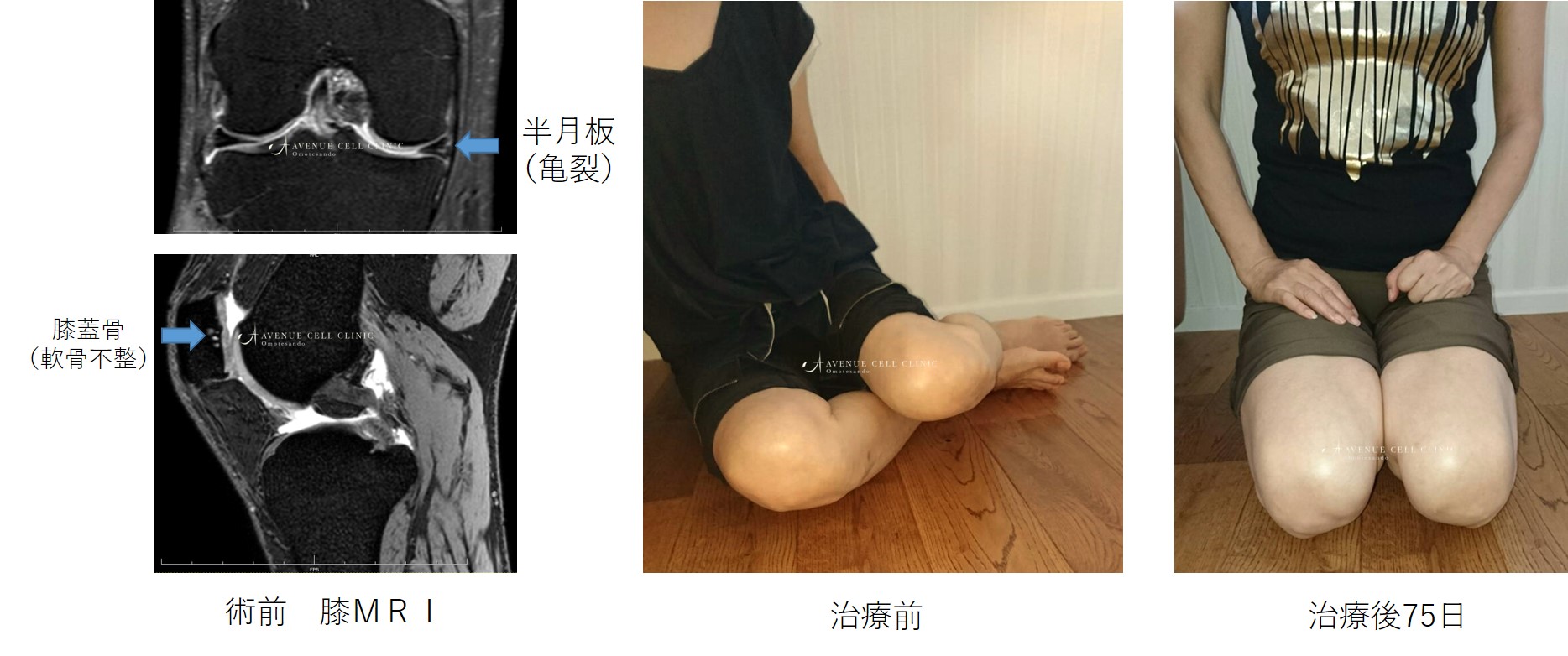 ブログ膝.jpg