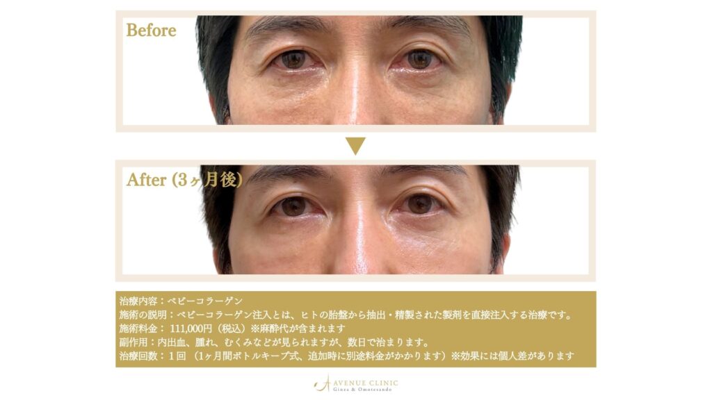ベビーコラーゲンビフォー&アフター症例写真