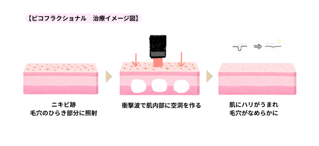 ピコフラクショナルのイメージ