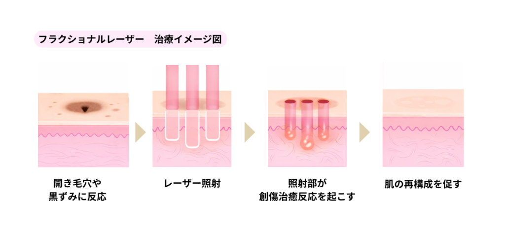 フラクショナルレーザーのイメージ