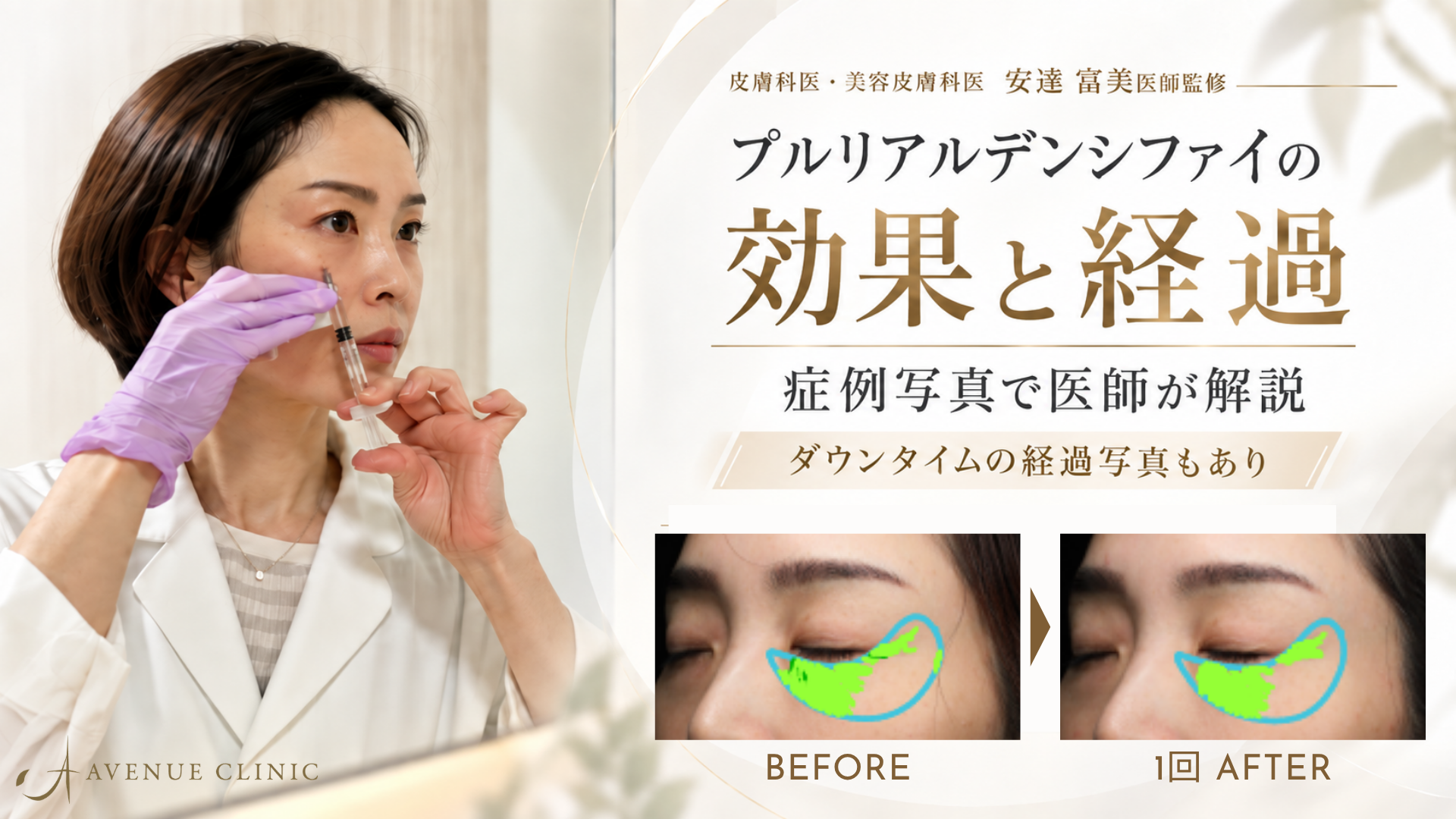 プルリアルデンシファイの効果と経過｜症例写真で医師が解説