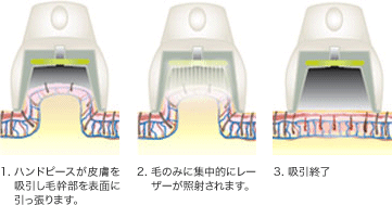 ダイオードレーザー脱毛のイメージ